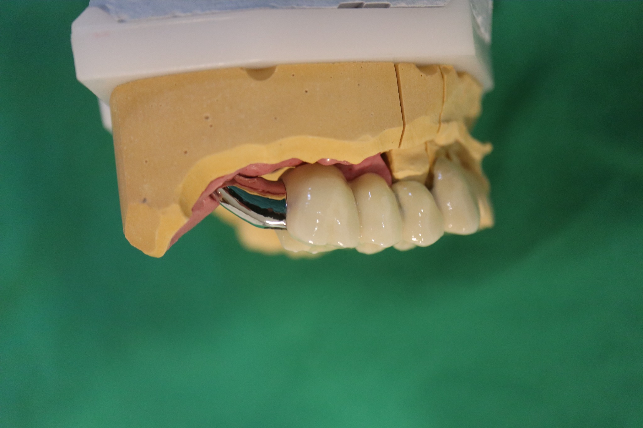 Pterygoid-Implantate